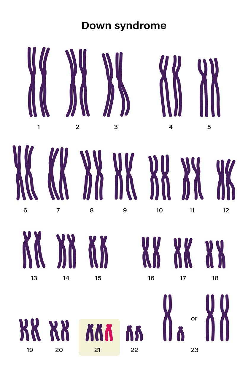 Illustration of chromosomes showing trisomy 21, the genetic cause of Down syndrome, often identified through genetic testing in IVF embryo screening