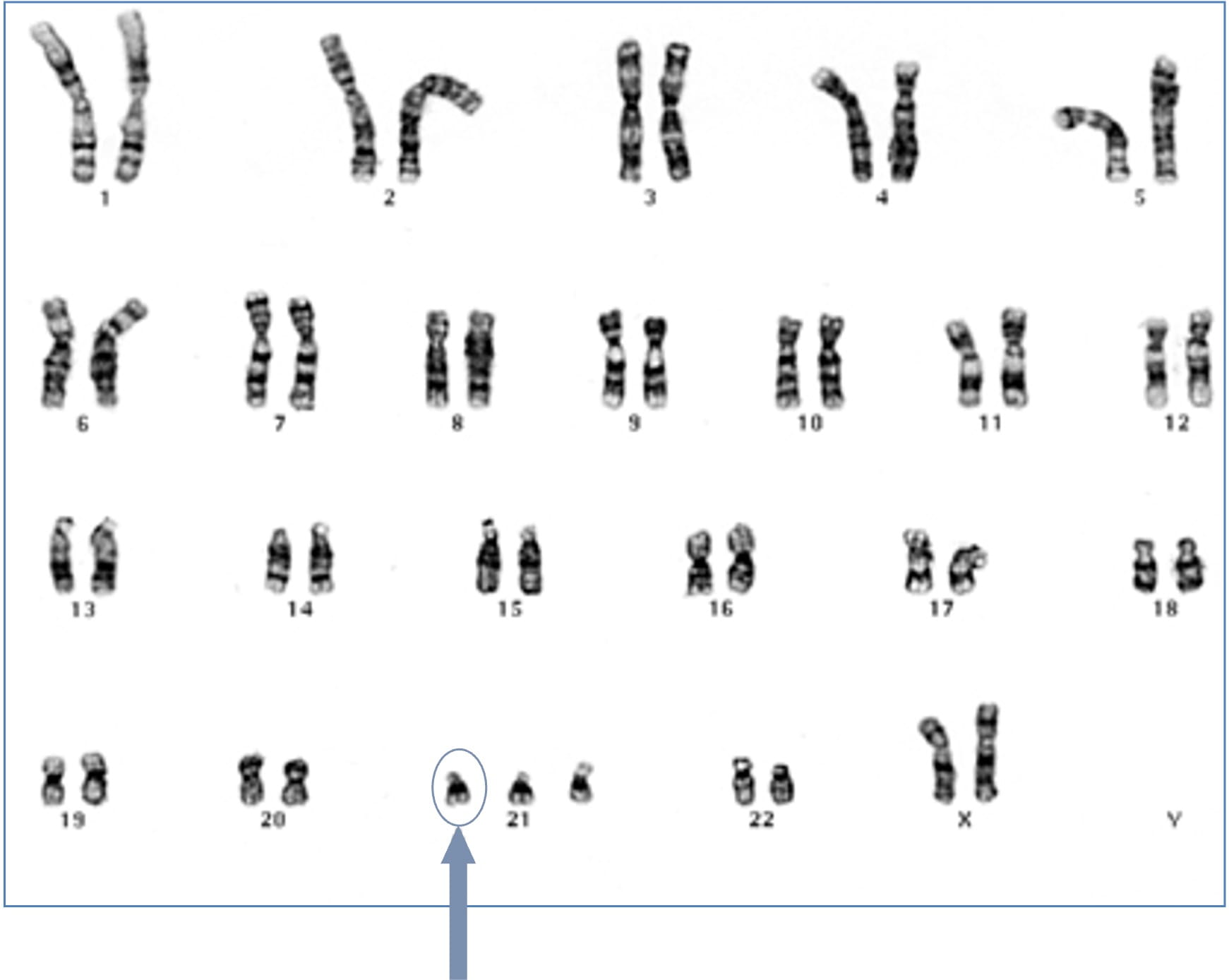 Fotografische weergave van een set menselijke chromosomen (karyotype), gerangschikt in homologe paren en op volgorde van nummer, met het syndroom van Down, waarbij er drie kopieën van chromosoom 21 zijn in plaats van twee.